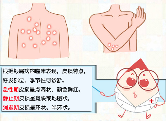 牛皮癣
