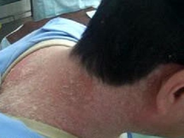 男性牛皮癣患者能要小孩吗？会遗传给孩子吗？