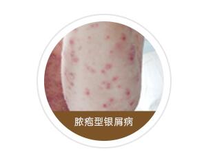 脓包型牛皮癣除了治疗外还有什么需要注意的？