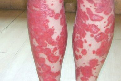 牛皮癣患者怎么预防红皮型牛皮癣？
