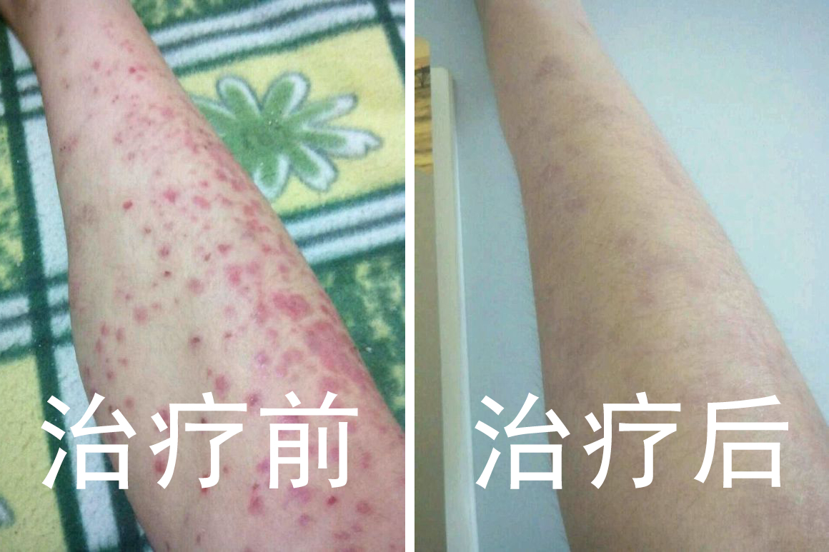 牛皮癣治疗